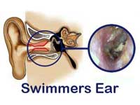 GtB Swimmers Ear